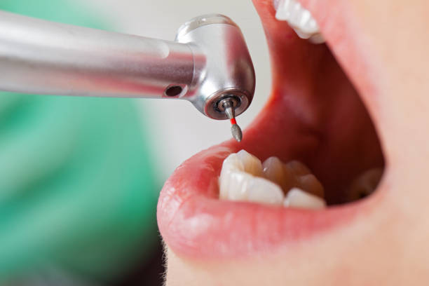 Best Emergency Dentist for Knocked-Out Tooth in Lindon, UT